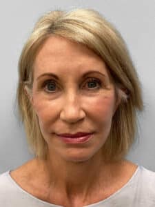 After Image: Browlift & Laser Resurfacing – Dr. Tucker