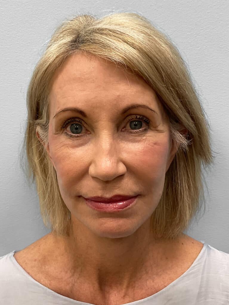 After Image: Browlift & Laser Resurfacing – Dr. Tucker - front