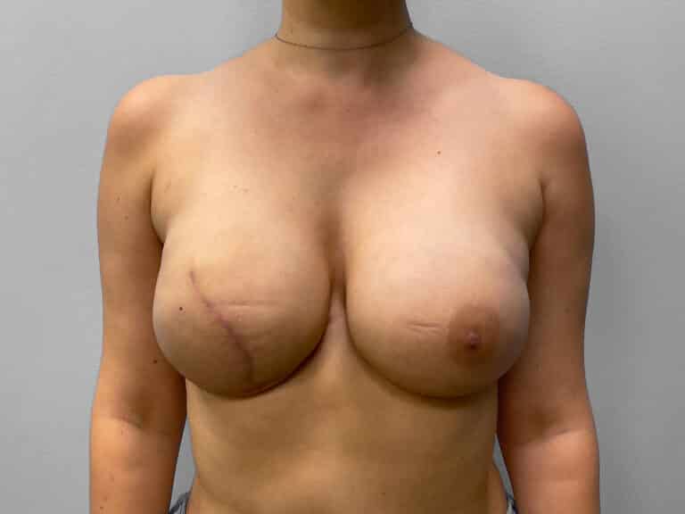 After Image: Breast Reconstruction – Dr. Tucker - front