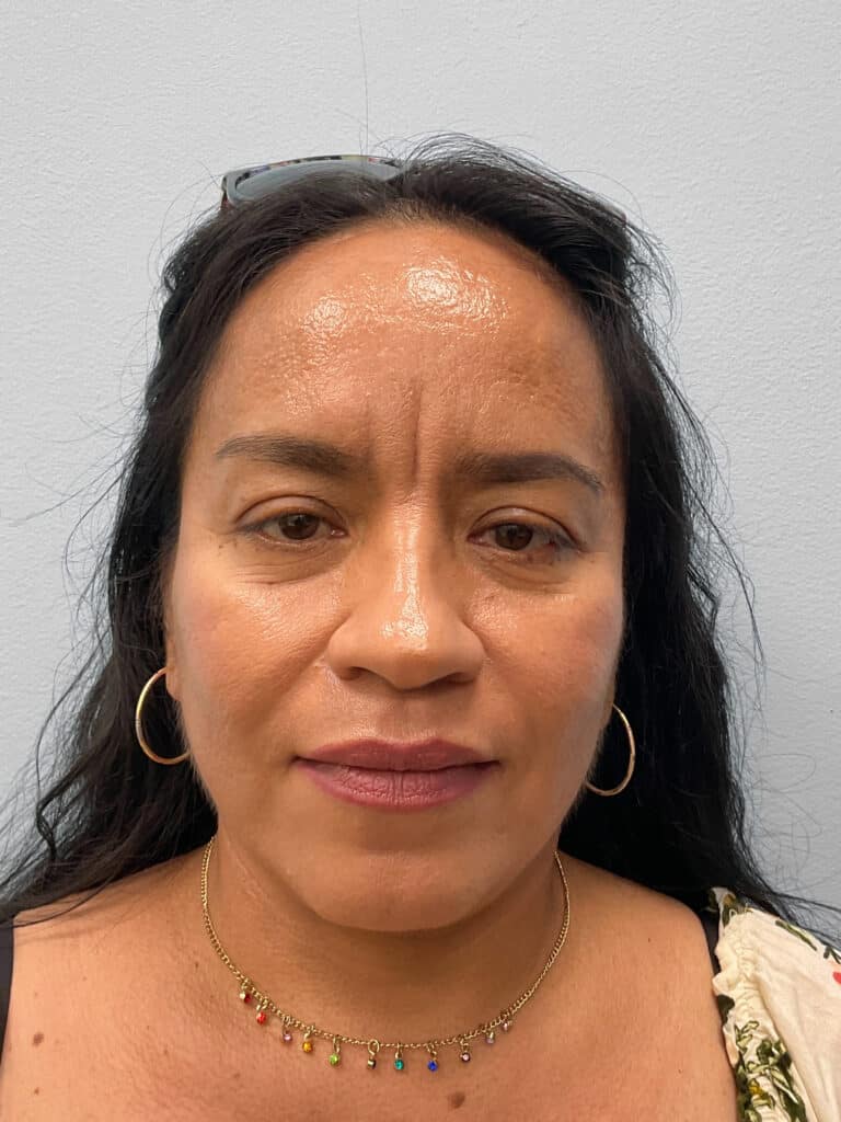 After Image: Face & Browlift – Dr. Tucker - front
