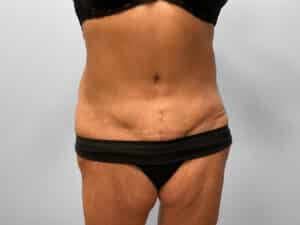 After Image: Tummy Tuck – Dr. Tucker