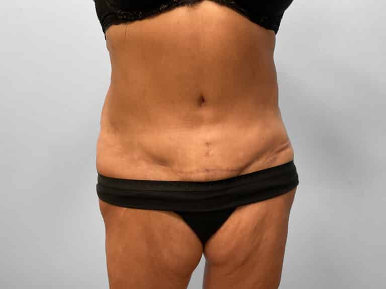 After Image: Tummy Tuck – Dr. Tucker - front