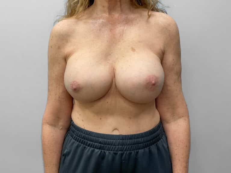 After Image: Breast Augmentation – Dr. Tucker - front