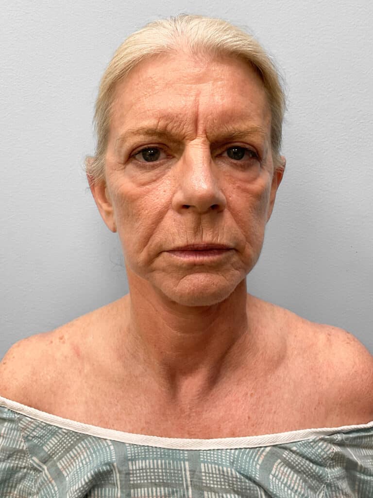 After Image: Facelift, Blepharoplasty, & TFX – Dr. Tucker - front