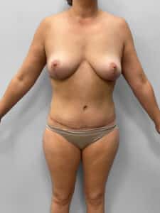After Image: Mommy Makeover – Dr. Tucker