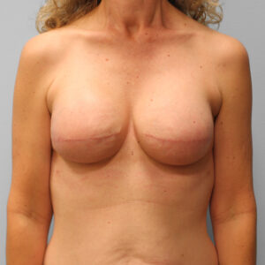 After Image: Breast Reconstruction – Dr. Tucker