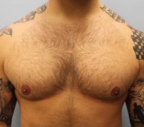 After Image: Gynecomastia- Dr. Howell - front