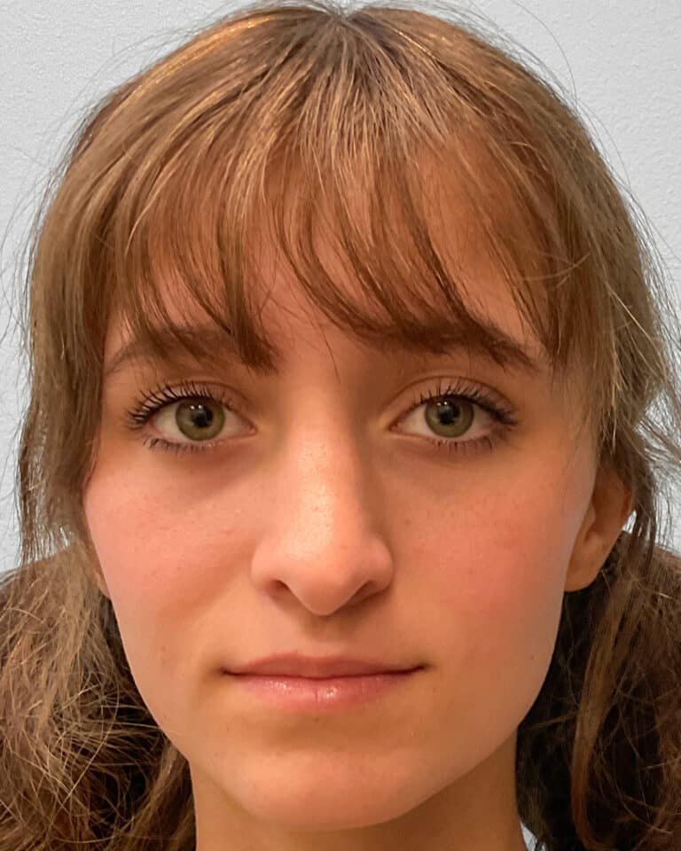 After Image: Rhinoplasty – Dr. Tucker - front