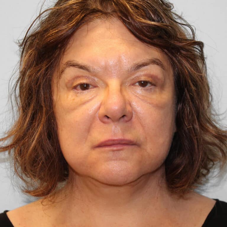 After Image: Facelift & Blepharoplasty – Dr. Tucker - front