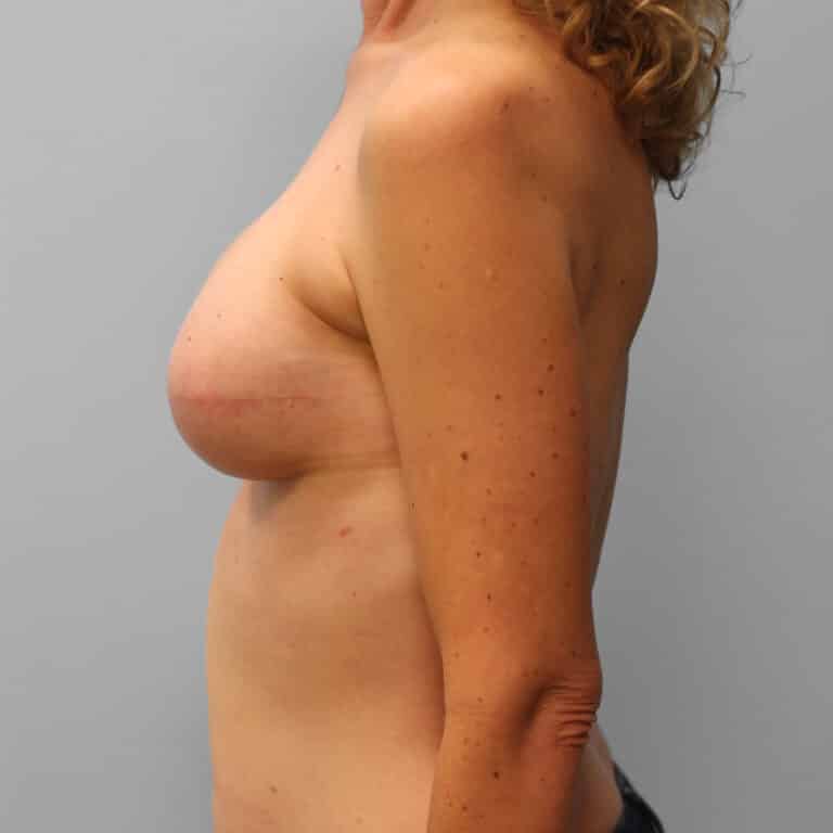 After Image: Breast Reconstruction – Dr. Tucker - left-side