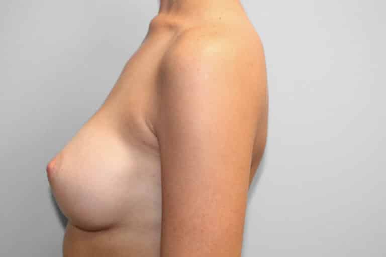 After Image: Breast Augmentation – Dr. Tucker - left-side