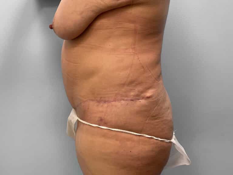 After Image: Mommy Makeover – Dr. Tucker -