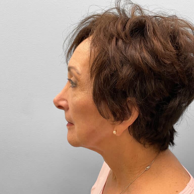 After Image: Blepharoplasty – Dr. Tucker - left-side