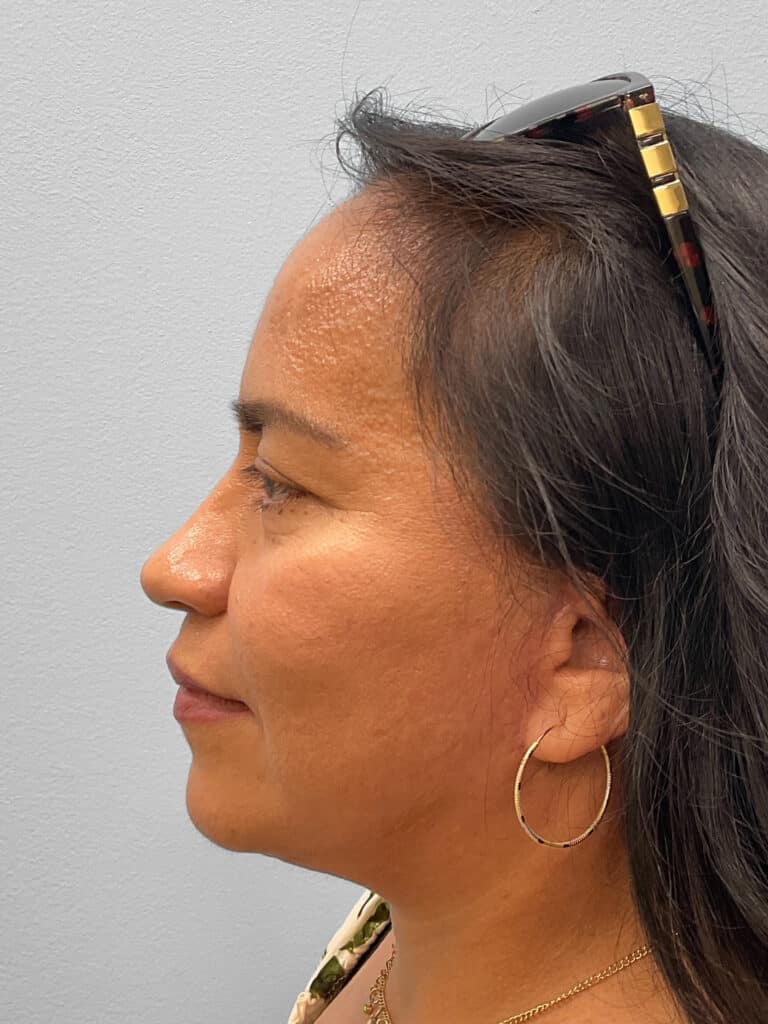After Image: Face & Browlift – Dr. Tucker - left-side
