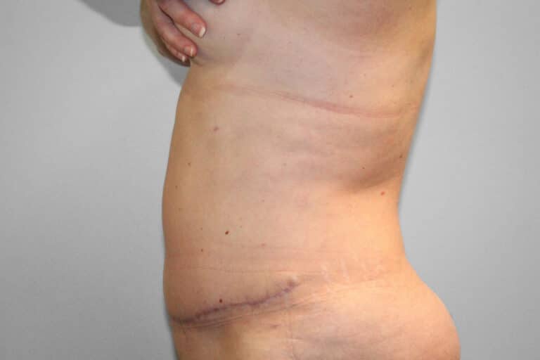 After Image: Abdominoplasty (Tummy Tuck) – Dr. Tucker - left-side