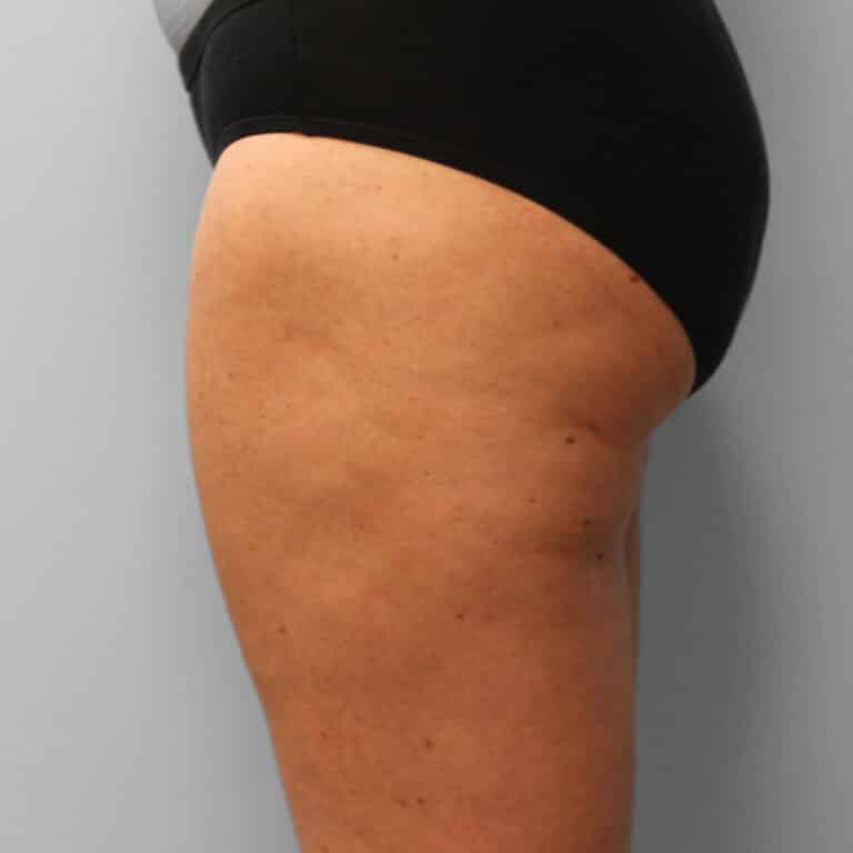 After Image: Mommy Makeover – Dr. Tucker - other