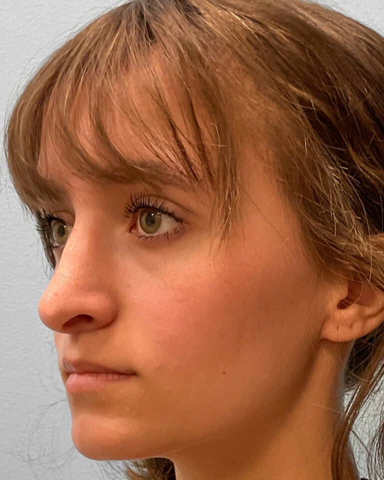 After Image: Rhinoplasty – Dr. Tucker - front