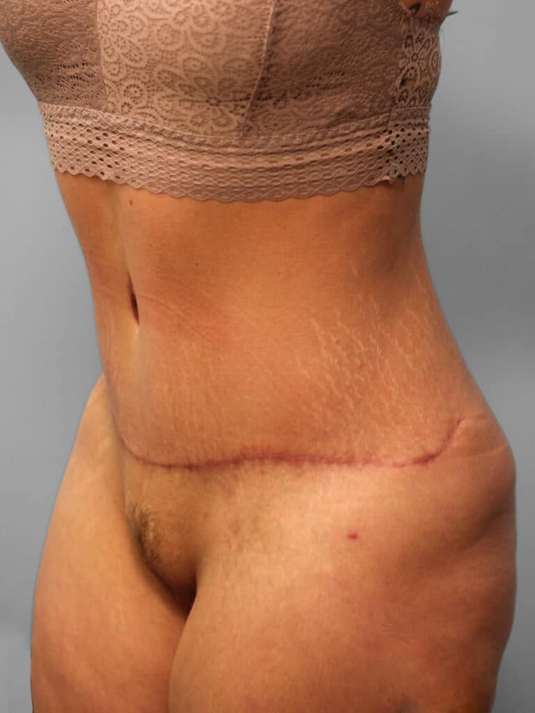 After Image: Abdominoplasty – Dr. Howell - left-front-oblique