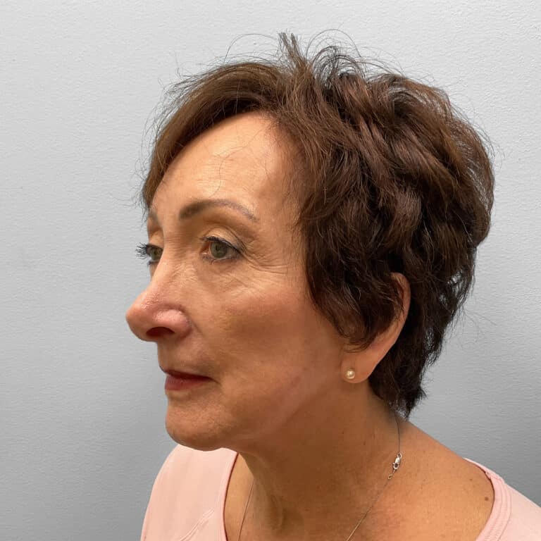 After Image: Blepharoplasty – Dr. Tucker - left-front-oblique