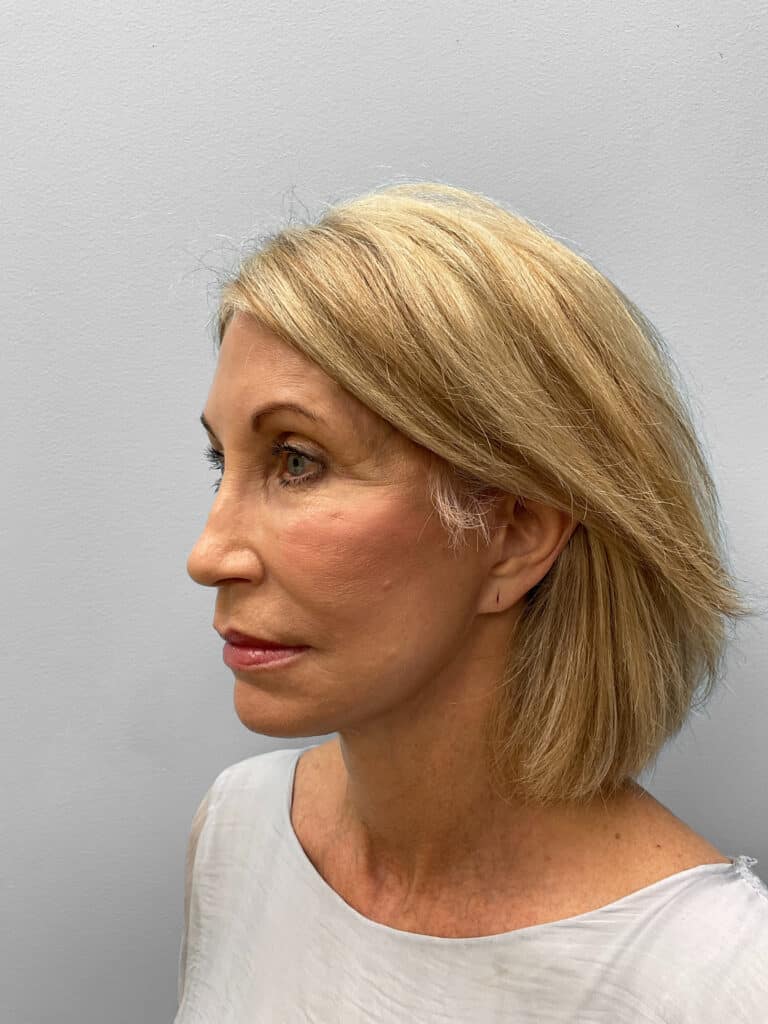 After Image: Browlift & Laser Resurfacing – Dr. Tucker - left-front-oblique