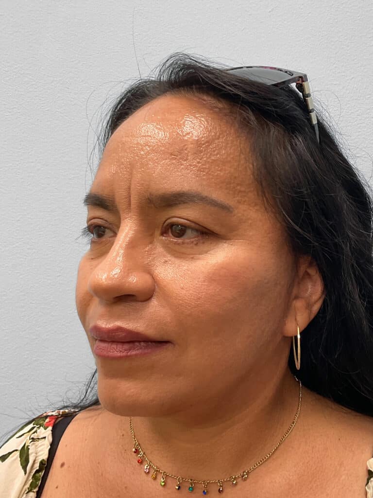 After Image: Face & Browlift – Dr. Tucker - left-front-oblique
