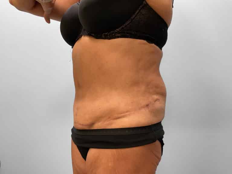 After Image: Tummy Tuck – Dr. Tucker - left-front-oblique