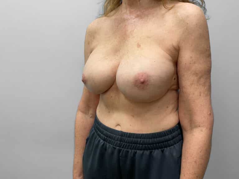 After Image: Breast Augmentation – Dr. Tucker - left-front-oblique