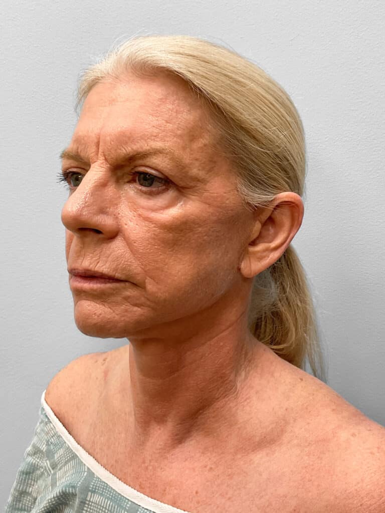After Image: Facelift, Blepharoplasty, & TFX – Dr. Tucker - left-front-oblique