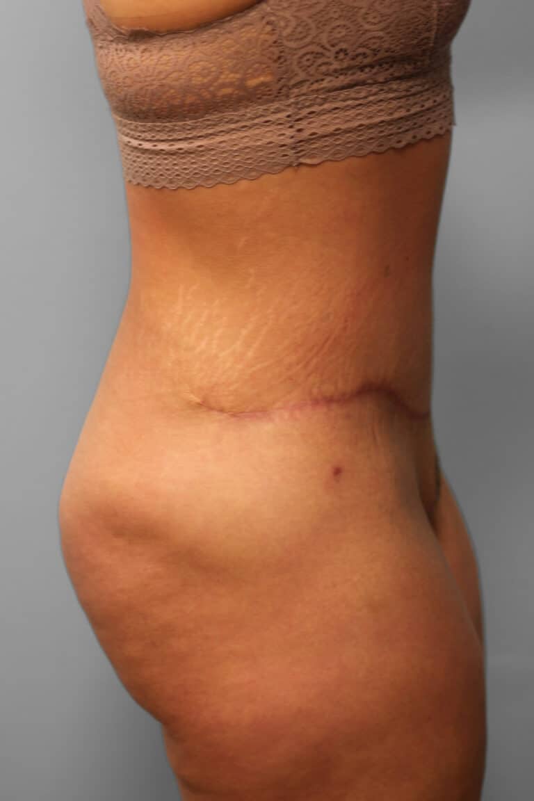 After Image: Abdominoplasty – Dr. Howell - right-side