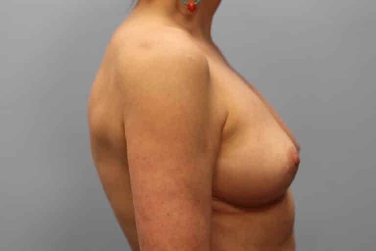 After Image: Breast Implant Revision- Dr. Howell - right-side