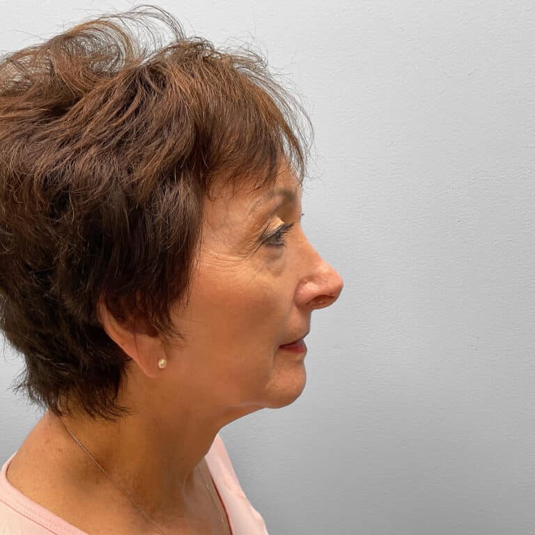 After Image: Blepharoplasty – Dr. Tucker - right-side
