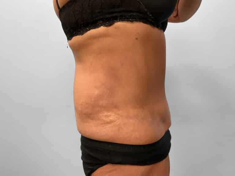 After Image: Tummy Tuck – Dr. Tucker - right-side