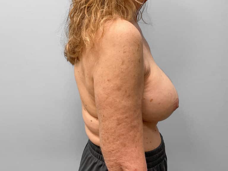 After Image: Breast Augmentation – Dr. Tucker - right-side