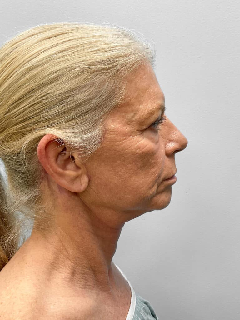 After Image: Facelift, Blepharoplasty, & TFX – Dr. Tucker - right-side