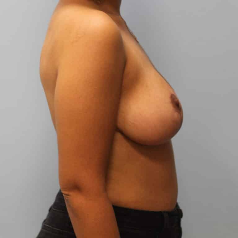 After Image: Breast Reduction-Dr.Howell - left-side