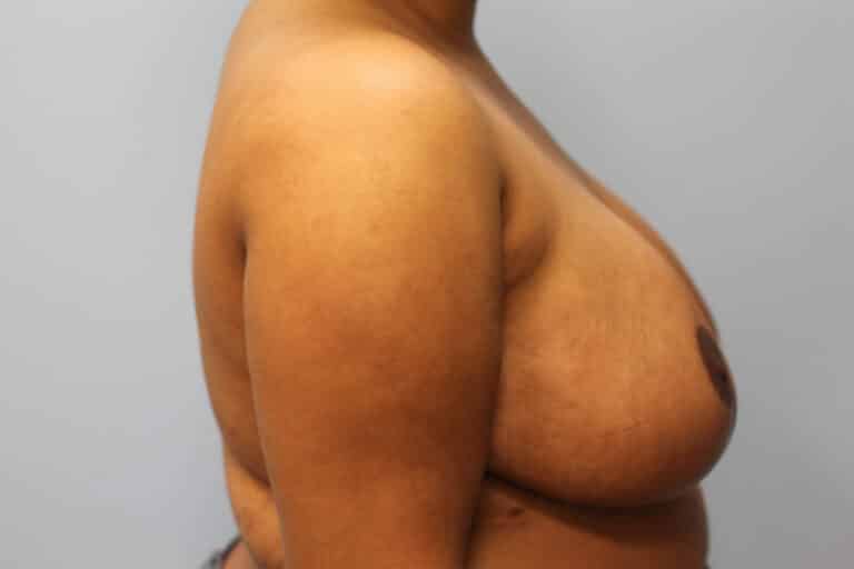 After Image: Breast Reduction – Dr. Howell - right-side