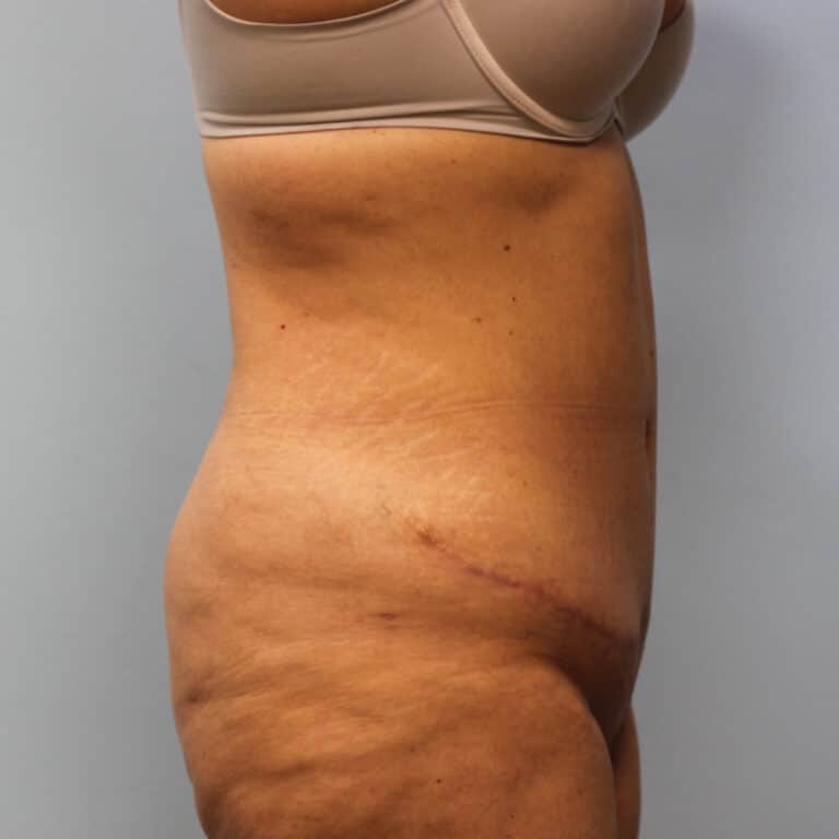 After Image: Abdominoplasty – Dr. Tucker - right-side