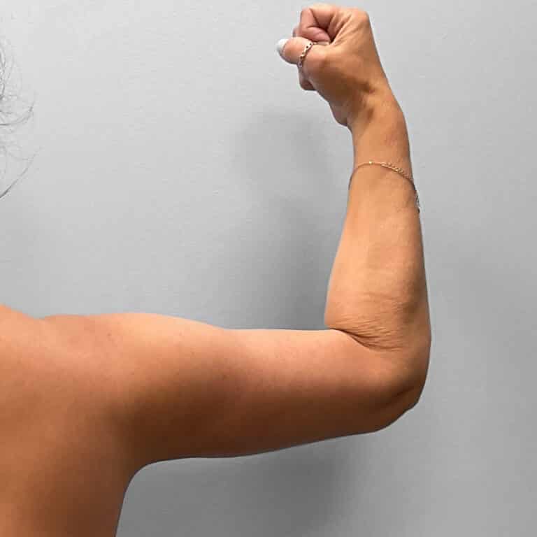 After Image: Mommy Makeover – Dr. Tucker - right-side