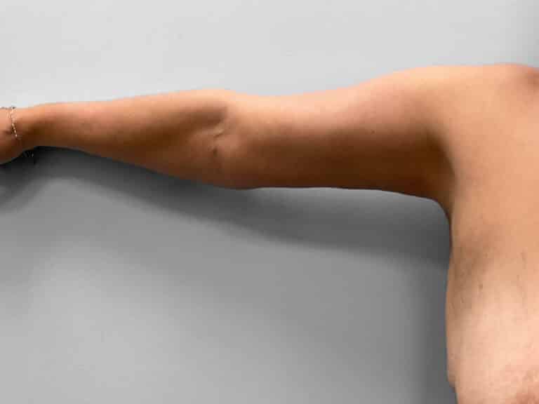 After Image: Mommy Makeover – Dr. Tucker - right-side