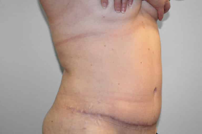 After Image: Abdominoplasty (Tummy Tuck) – Dr. Tucker - right-front-oblique