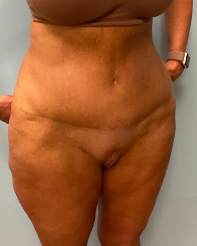 After Image: Abdominoplasty & Thigh Lift – Dr. Tucker - right-front-oblique
