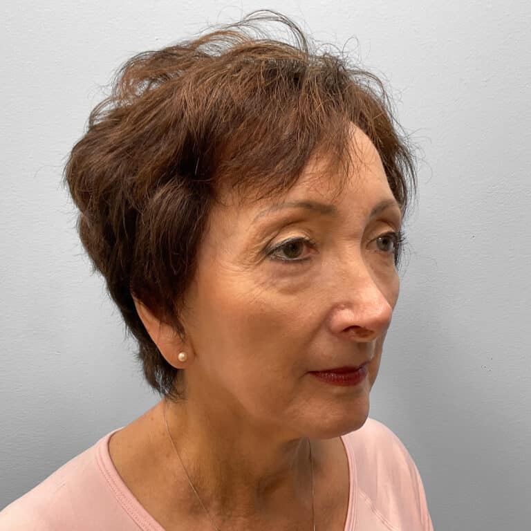 After Image: Blepharoplasty – Dr. Tucker - right-front-oblique
