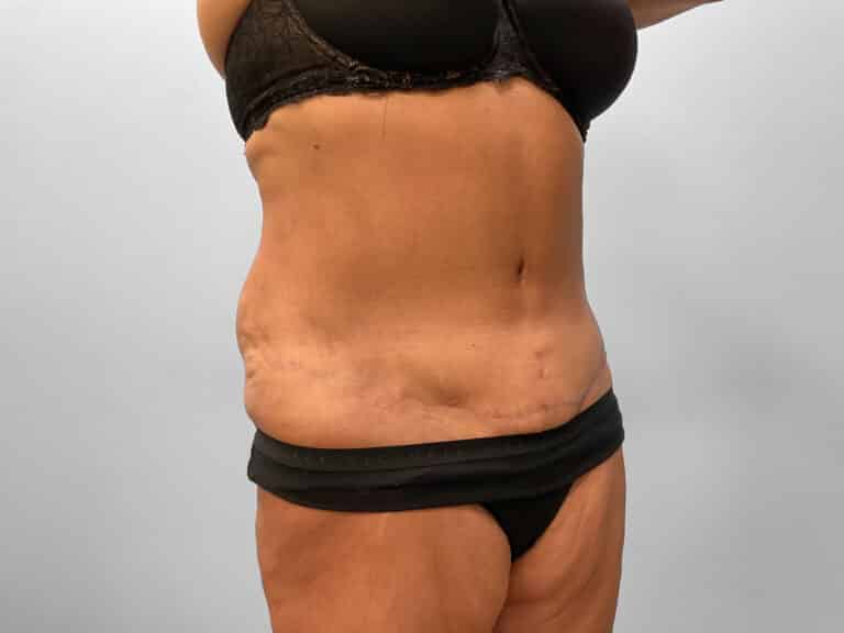 After Image: Tummy Tuck – Dr. Tucker - right-front-oblique