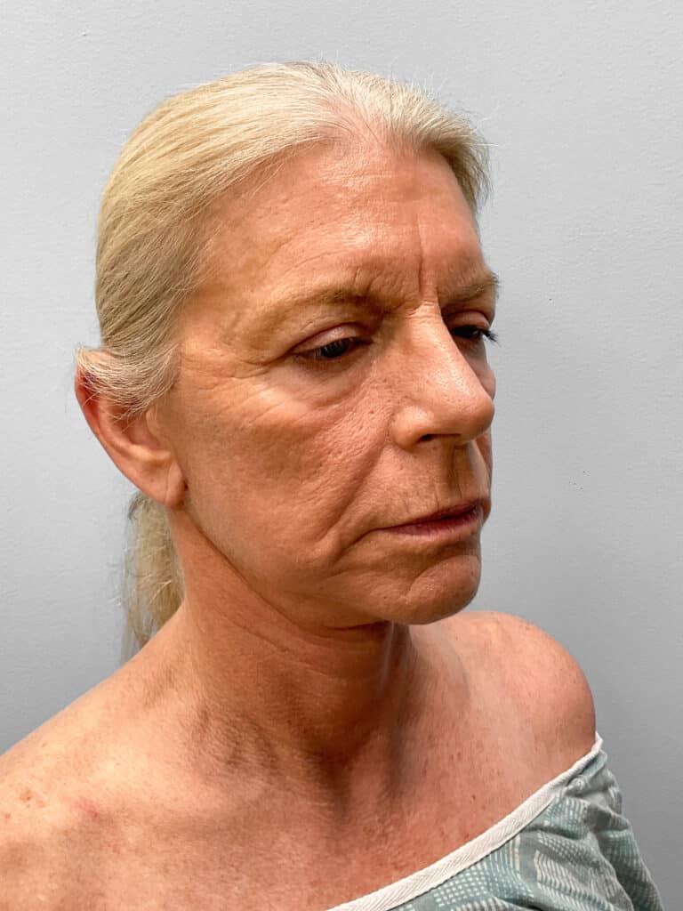 After Image: Facelift, Blepharoplasty, & TFX – Dr. Tucker - right-front-oblique