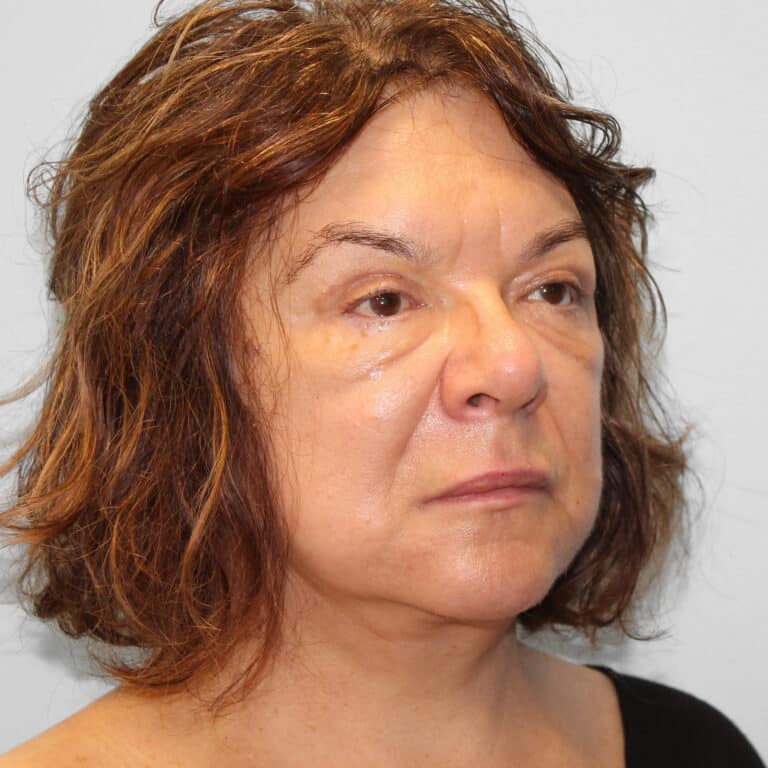 After Image: Facelift & Blepharoplasty – Dr. Tucker - right-front-oblique