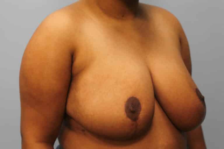 After Image: Breast Reduction – Dr. Howell - right-front-oblique