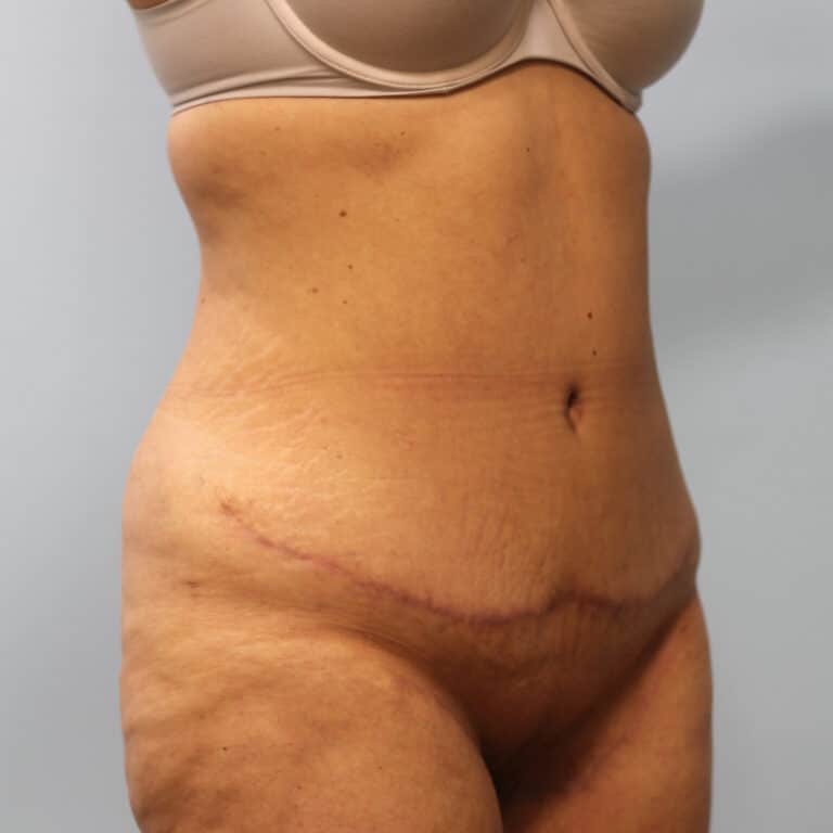After Image: Abdominoplasty – Dr. Tucker - right-front-oblique