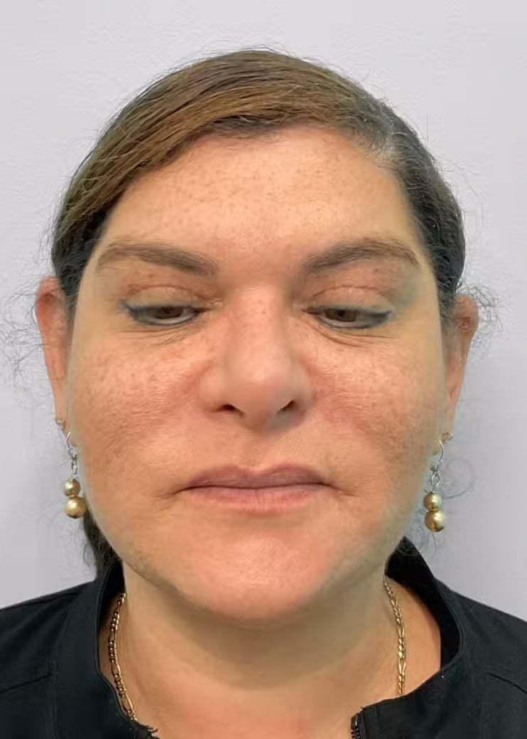 After Image: Kybella- Joy - front