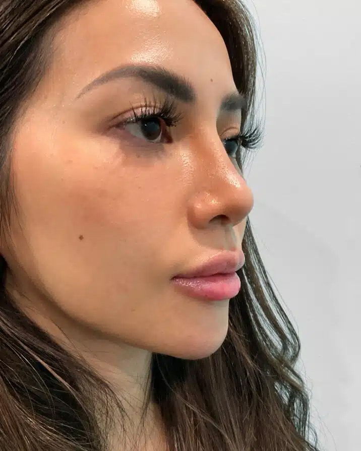 After Image: Juvéderm Volbella & Botox – Heather - right-front-oblique