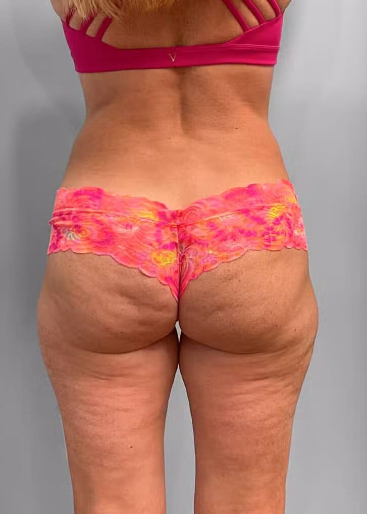 After Image: Emsculpt Neo- Jessica - back